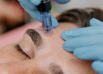 Close-up of a person receiving a microneedling treatment on the forehead from a practitioner wearing blue gloves.